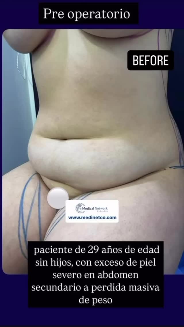 Pour un devis en Colombie à Bogota , écris moi sûr messenger 🤍🤍🤍
#agenceaandbeauty • #PlasticSurgeryColombia
• #CosmeticSurgeryAbroad
• #MedicalTourismColombia
• #BeforeAndAfterTransformation
@medinetco @recoveryhomecolombia
