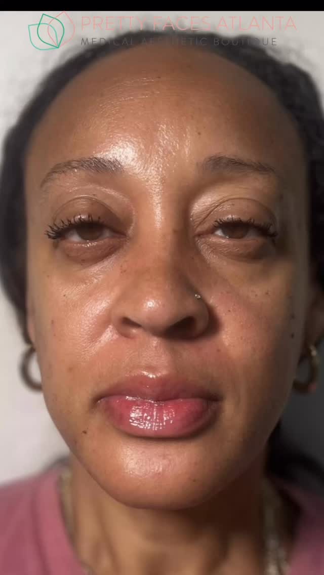This wasn’t just one treatment… this was a full facial reset built to lift, smooth, and restore all at once:
💉 PDO Threads
Placed to physically lift sagging skin, define the jawline, and reposition facial structure. This also stimulates collagen over time so the results keep improving.
🩸 PRP Under Eyes
Using your body’s own growth factors to brighten dark circles, improve texture, and thicken thin under eye skin for a more awake look.
💉 Botox
Targeted injections to relax wrinkles (forehead, frown lines, crow’s feet) while also slimming and sculpting areas like the jaw for a more contoured finish.
✨ Why this combo works:
Most people try to fix everything with one treatment… but aging happens in layers. This approach tackles:
• Skin laxity (threads)
• Volume + darkness (PRP)
• Movement + wrinkles (Botox)
That’s how you get a result that looks balanced, natural, and actually transformative.
No surgery. Minimal downtime. Real results.
If you’ve been:
• Lifting your face in the mirror
• Tired of looking “drained” even when you’re not
• Noticing lines and loss of definition
This is exactly what you’ve been looking for.
📍 Pretty Faces Atlanta
📲 Book your consultation and let’s map out your custom transformation
#PrettyFacesAtlanta #FullFaceTransformation #PDOThreads #Botox #PRPResults