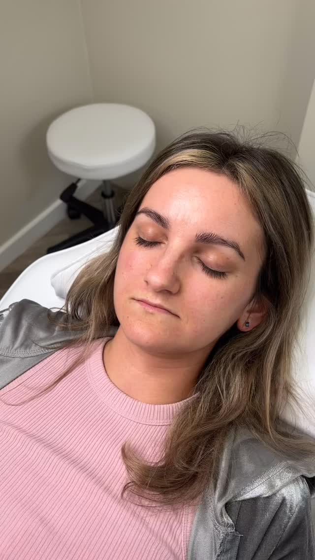 Deep understanding of anatomy matters! It’s not just a few injections and done ⬇️
What are M-shaped lips?
M-shaped lips are defined by a pronounced Cupid’s bow, creating two peaks on the upper lip that resemble the letter “M”. This natural structure gives the lips a more sculpted, heart-like appearance.
Key features:
• Defined, lifted Cupid’s bow
• Two visible peaks on the upper lip
• Often a slightly fuller centre with tapered sides
• Can appear more structured than soft/rounded lip shapes
Why it matters in aesthetics:
Understanding lip shape is EVERYTHING when it comes to filler. M-shaped lips need a tailored approach. Overfilling the centre or blurring the Cupid’s bow can completely lose that natural definition.
Treatment approach 💉
• Focus on enhancing, not flattening the Cupid’s bow
• Subtle volume through the body of the lip
• Strategic placement to maintain structure
• Balance between top and bottom lip
CeTe approach:
At CeTe Aesthetics, every lip is mapped and treated based on its unique anatomy to keep results natural, balanced and long-lasting.
——
#mshapedlips #lincolnshireaesthetics #scunthorpeaesthetics #scunthorpebusiness #lipfillers