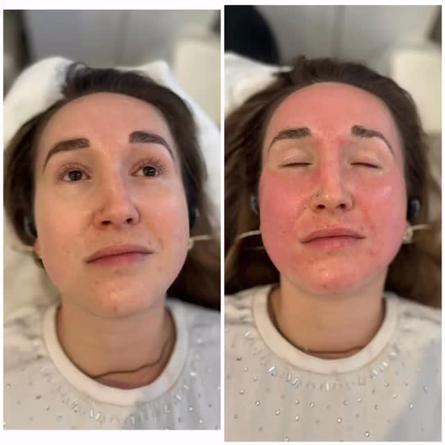 Thinking about microneedling? Here’s what you NEED to know 👇. Struggling with acne scars or dull skin? This might change everything ✨
Microneedling before & after results you’ll love 💉#fulham #skincare #microneedling #