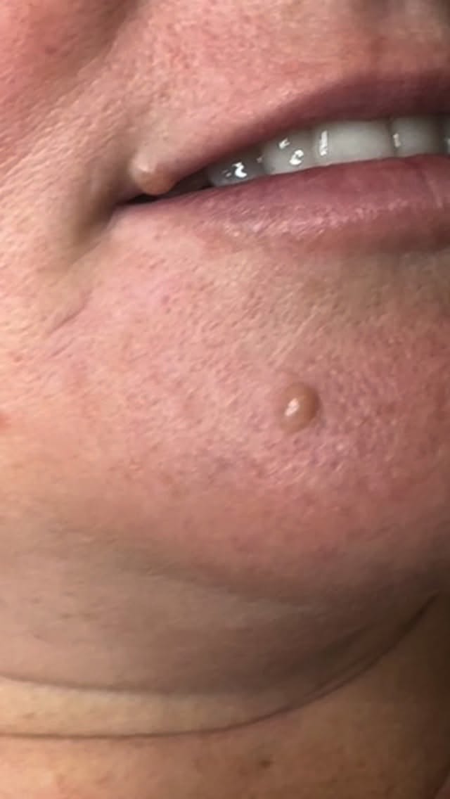 Mole removal made simple
Using our advanced Accor Plasma Pen technology, we can safely and effectively remove selected benign moles following appropriate skin checks — with beautifully refined results and minimal downtime.
Downtime is typically 5–7 days (occasionally up to 10 days depending on the lesion and healing response), and with the correct medical aftercare cream, healing is smooth and results are exceptional.
If you have a mole you’ve been considering removing and would love to know if you’re a suitable candidate…
SMS Angie directly on 0411 699 227 with a clear photo for assessment 📲
Beautiful results. Minimal downtime. Expert care.
#MoleRemoval #PlasmaPen #CorePlasmaPen #SkinClinicNoosa #AboutFacesNoosa NoosaSkinClinic SkinLesionRemoval AdvancedAesthetics DermalTherapy NoosaBeauty SkinExperts AestheticClinic ConfidenceInYourSkin