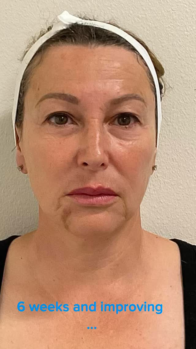 #sarasotaflorida #hifu #capricebeautybar #sarasota #sarasotaskincare
Hifu is non surgical face treatment for younger lifted appearance…
Get your 25% off
Free consultation
Capricebeautybar.com