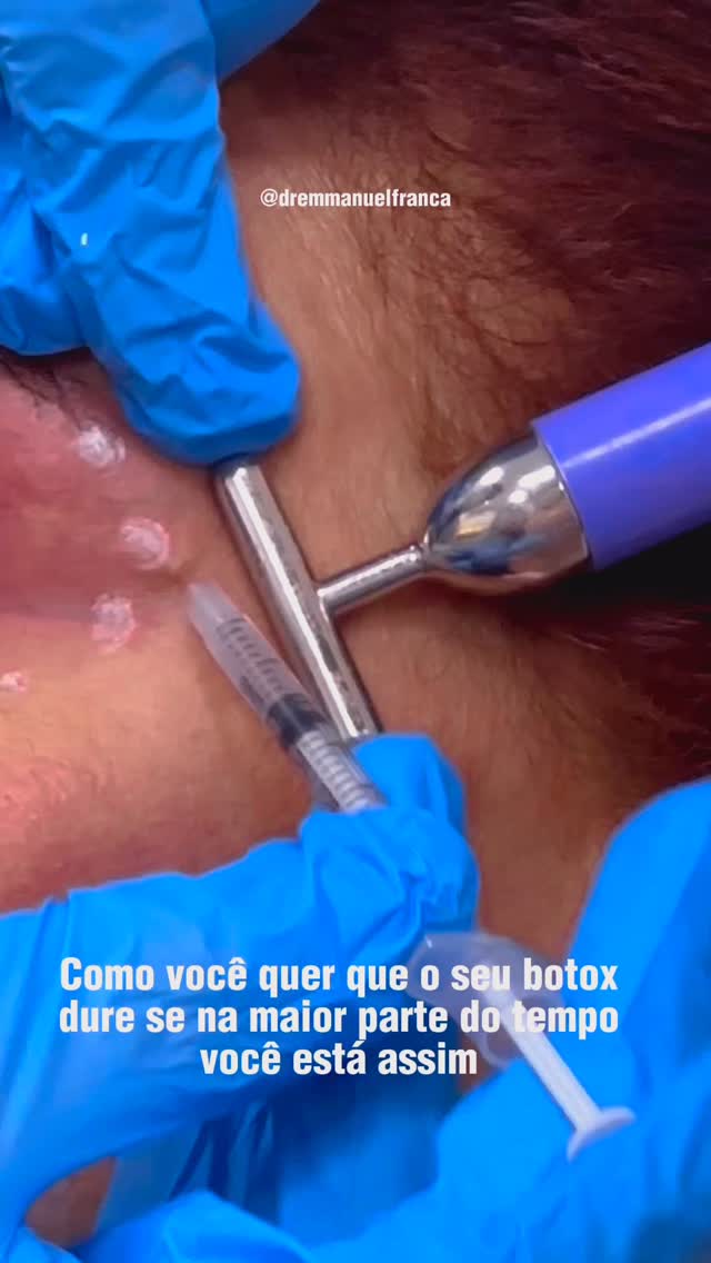 A durabilidade da toxina botulínica não depende só do produto, o seu padrão muscular também influencia muito.
Pessoas que têm uma musculatura facial mais forte, fazem muitas expressões (testa, olhos, sorriso) ou contraem o rosto com frequência tendem a “consumir” o efeito mais rápido.
Isso acontece porque a toxina age justamente reduzindo a contração muscular e quanto mais ativo esse músculo, maior o desgaste ao longo do tempo.
Por isso, a duração não é igual para todos. Avaliar a força muscular e o padrão de movimento de cada paciente é essencial para ajustar dose, técnica e intervalo de reaplicação — sempre buscando naturalidade e equilíbrio. 💉
Dr Emmanuel França
Dermatologista
CRM 5999
RQE 636