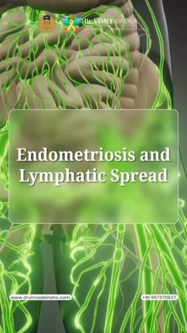 Repost from @endometriosissurgeon_india #endowarriorsaotearoa #endometriosisawareness #endometriosis #endowarriors