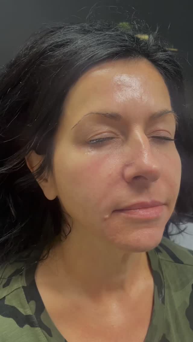 Opus works by delivering controlled plasma energy into the skin to stimulate collagen and improve texture + tone.
Downtime is minimal, most clients experience redness and warmth for a couple of days, followed by gradual skin renewal.
It’s one of our favourite treatments for natural-looking skin improvement.
For April, we’re offering Opus at $599 (regular $799)
#beauty #niagarafallscanada #aestheticnurse #results #opus