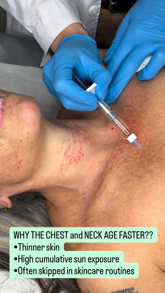 Don’t forget your neck and décolleté… 👀✨
Because you can treat your face perfectly, but your chest and neck will still whisper your age if left behind.
Treatments to consider for these areas:
• Polynucleotides
• Microneedling
• Microneedling + PRP
• Skin boosters
• LED light therapy
Skin quality matters everywhere 🤍
#SkinRejuvenation #Polynucleotides #microneedlingtreatment #collagen