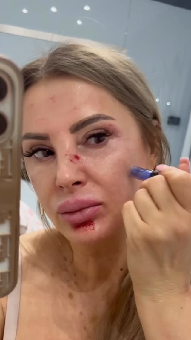 ✨ Jünger aussehen ist heute kein Problem mehr ✨
Heute mache ich bei mir selbst Microneedling 💉
Wichtig: Ich gleite nicht einfach über die Haut, um sie „aufzureißen“. Stattdessen arbeite ich punktuell, um gezielte, minimale Mikroverletzungen zu setzen. Dadurch wird die Kollagenneubildung angeregt und die Haut regeneriert sich von innen heraus 🔬✨
💧 Während der Behandlung werden hochwirksame Peptide in die Haut eingearbeitet für maximale Ergebnisse.
⚡️
Anschließend arbeite ich mit der 448 kHz Frequenz, die die Zellregeneration zusätzlich stimuliert und die Hauterneuerung unterstützt.
Das Ergebnis?
🌿 Glatte
🌿 Straffe
🌿 Ebenmäßige Haut
Make-up wird fast überflüssig 💁♀️✨
#microneedling #hautpflege # #antiaging #glowingskin beautyexpert kollagenboost skincare selfce