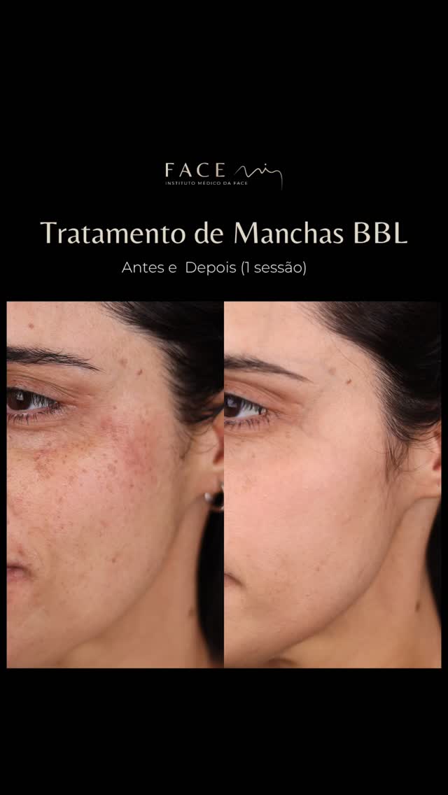 Existe um Antes e Depois de BBL. 🤩
Diga adeus às manchas causadas por aquela exposição solar na adolescência 🤦🏼♀️
Diga olá a uma pele renovada, mais luminosa e saudável 😏
#laserbbl #facemi #medicinaestetica #facemibraga #manchasnapele
Os casos clínicos apresentados refletem o antes e depois de pacientes específicos. Cada pessoa é única e o resultado pode variar de paciente para paciente.
Todos os pacientes, antes de cada procedimento, passam por um processo de consulta médica de diagnóstico onde são avaliadas indicações, expectativas e motivações.
Registo ERS: 21236
Registo estabelecimento: E159774
Licença funcionamento: 21236/2022