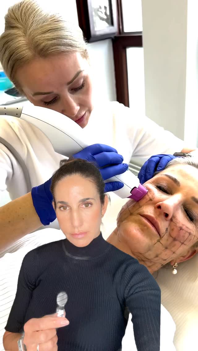 Thermage und Morpheus8 werden oft miteinander verglichen – dabei haben beide Verfahren ihre ganz eigene Stärke.
Thermage eignet sich besonders dann, wenn es um Hautstraffung, Konturverbesserung und tiefere Gewebestimulation geht – ganz ohne Nadeln und mit wenig Downtime. Ideal bei beginnender bis moderater Erschlaffung, wenn die Haut fester und definierter wirken soll.
Morpheus8 arbeitet mit Microneedling plus Radiofrequenz und ist vor allem dann spannend, wenn neben Straffung auch Hautbild, Poren, feine Linien oder Aknenarben verbessert werden sollen.
Wann was?
✨ Thermage: eher bei Fokus auf Straffung, Kontur und Tiefe
✨ Morpheus8: eher bei Struktur, Textur und zusätzlichem Remodeling
✨ Kombination: wenn sowohl Laxität als auch Hautqualität Thema sind und wir verschiedene Ebenen gezielt ansprechen möchten
Entscheidend ist nicht, was gerade Trend ist – sondern was zu deiner Haut, deinem Gewebe und deinem Ziel passt.
Genau deshalb ist eine individuelle Beurteilung so wichtig.
Buche dir gerne deinen Beratungstermin – wir schauen gemeinsam, welche Behandlung oder Kombination für dich wirklich sinnvoll ist.
Schreib mir THERMAGE oder MORPHEUS in die Kommentare oder per DM, wenn du unsicher bist, was besser zu dir passt.
#thermage #morpheus8 #hautstraffung #skinremodeling #radiofrequenz microneedling