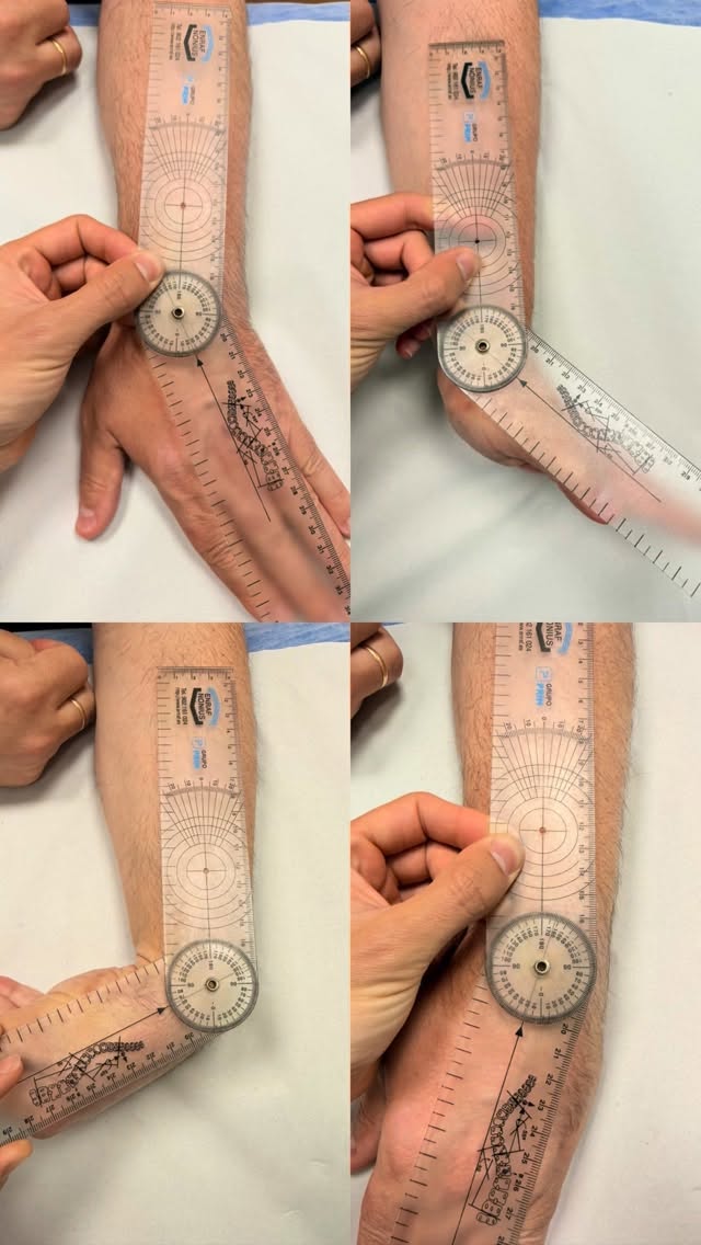 ⚒️ Fractura huesos de la mano 🖐🏼
Fase intermedia en fractura de huesos de la mano. El paciente acude tras 5 semanas de inmovilización. Buscamos como principal objetivos:
- Recuperar ROM articular ➡️ terapia manual
- Disminución de dolor e inflamación ➡️ tecarterapia
- Fortalecimiento muscular analítica y del miembro afecto
#rehab #fisioterapiadeportiva #muñeca #wrist