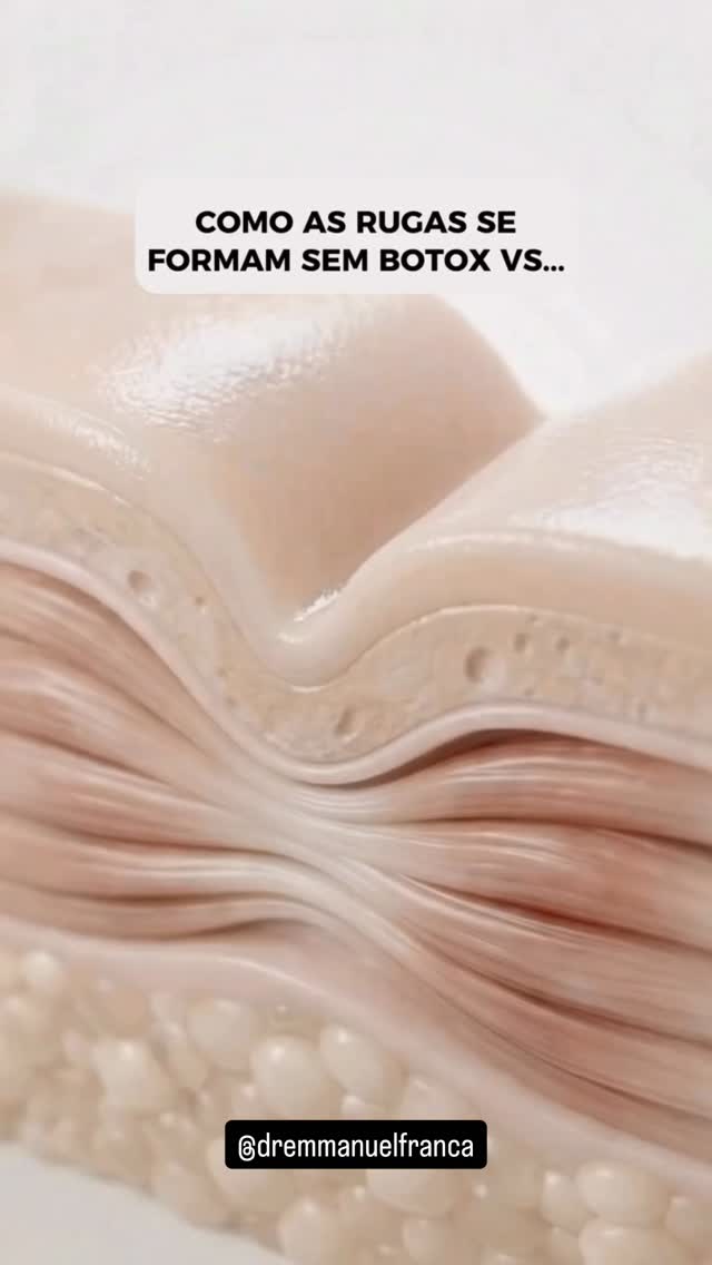 As rugas não aparecem de uma vez, elas são formadas ao longo do tempo, como um caminho que vai sendo repetido todos os dias.
Quando você movimenta o rosto (sorrir, franzir a testa, apertar os olhos), surgem as chamadas rugas dinâmicas, aquelas que aparecem apenas durante a expressão. Com o passar dos anos, a pele perde colágeno e elasticidade, e essas mesmas linhas começam a permanecer mesmo em repouso. Aí surgem as rugas estáticas.
Sem intervenção, esse processo continua evoluindo: quanto mais o músculo contrai, mais aquela “marca” vai sendo reforçada na pele.
A toxina botulínica atua justamente nesse ponto. Ela reduz a contração muscular, diminuindo a formação dessas linhas repetitivas. Com isso, conseguimos suavizar as rugas dinâmicas e, principalmente, evitar que elas se transformem em rugas estáticas mais profundas.
Não é sobre “paralisar” o rosto, mas sobre modular a força muscular com estratégia, preservando a naturalidade e retardando esse processo de marcação da pele ao longo do tempo. 💉
Dr Emmanuel França
Dermatologista
CRM 5999
RQE 636
📍Skin Prime - Riomar Trade Center - Torre 3 - Sala 1905
☎️ (81) 3036-4040