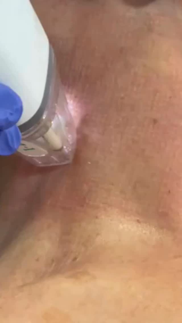 |DERMATOLOGIA|
Un dels primers signes d'envelliment facial és la flacciditat al terç inferior i al coll. La pell, molt fina, perd tonicitat i es comença a despenjar.
Potenza (radiofreqüència amb microagulles) és un tractament patentat per tal de generar elastina i col·lagen que milloraran la compactació de la pell i, per tant, reduirà la flacciditat.
Recomanem realitzar 3 sessions a l'any i després 1 sessió de manteniment.