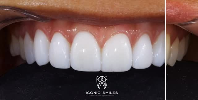 The confidence boost that changed everything? It all started with my smile 😁
Your smile is the first thing people notice, and it should make YOU feel incredible too.
For years, maybe you’ve covered your mouth when you laughed, avoided photos, or felt self-conscious about your teeth. But imagine waking up every day absolutely loving your smile.
That’s the magic of veneers.
It’s not just about having perfect teeth – it’s about the transformation that happens inside. When you love your smile, everything changes:
✨ You laugh without holding back
✨ You speak with more confidence
✨ You shine brighter in every photo
✨ You feel like the best version of yourself
Your dream smile isn’t just a cosmetic change – it’s an investment in your confidence, your happiness, and how you show up in the world.
Because when you love your smile, the whole world gets to see you glow.
#VeneersTransformation #SmileMakeover #ConfidentSmile #DreamSmile #SmileGoals