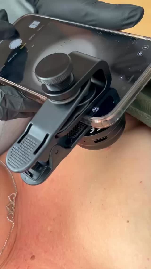 Worried about a mole or skin lesion? 🤔🔎
Our mole checking service gives you fast access to a UK consultant dermatologist’s opinion using high-quality dermoscopic images captured at London Road Clinic and securely reviewed via Map My Mole.
You’ll receive a clear report with reassurance, advice to monitor, or a recommendation for referral - typically within 24-48 🤍🔎🔦
📍London Road Clinic: 65 London Road, Newark NG24 1RZ
📞 01636 680767
📧 hello@londonroadclinic.com
🔗 Booking link in bio