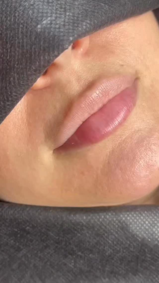 DEBUNKING MYTHS this morning 👇🏽
‘Russian lip filler migrates or doesn’t last’ 🤥
My client had one session with me in 2023, her second session 2 years ago in 2024 and we’ve just topped up 💁🏼♀️
No migration, still filler clearly visible and heart shaped with central volume after 2 years and a conservative amount injected overall 😏
𝗕 𝗬 𝗟 𝗢 𝗡 𝗗 𝗢 𝗡 𝗔 𝗘 𝗦 𝗧 𝗛 𝗘 𝗧 𝗜 𝗖 𝗦
📍 High Road, Wood Green, North London
▪️ Russian Lips
▪️ Full Facial Contouring + Balance
▪️ Liquid Rhinoplasty + Pixie Tip Lift
▪️ Skin Boosters, Polynucleotides + Exosomes
▪️ Anti Wrinkle Advanced
▪️ PDO Threads
📃 𝗖𝗣𝗗 𝗔𝗰𝗰𝗿𝗲𝗱𝗶𝘁𝗲𝗱 𝗧𝗿𝗮𝗶𝗻𝗶𝗻𝗴 𝗳𝗼𝗿 𝗔𝗲𝘀𝘁𝗵𝗲𝘁𝗶𝗰 𝗜𝗻𝗷𝗲𝗰𝘁𝗼𝗿𝘀
👩🏻🎓 Pathway & Beginners Packages
🥇 Advanced Level Masterclasses
💻 Online Courses available
📞 WhatsApp 07774 054 013
#russianlips #russianlipfiller #naturallips #naturallipfiller #heartshapedlips