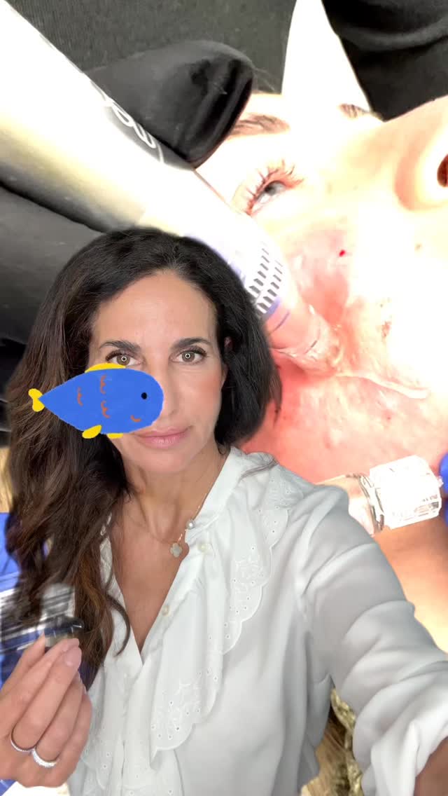 Polynukleotide gehören für mich zu den spannendsten Behandlungsmethoden, wenn es um Biostimulation, Hautqualität und einen eher präventiven Ansatz geht.
Warum?
Weil hier nicht das reine Auffüllen im Vordergrund
Sondern die Frage:
Wie kann ich Gewebe frühzeitig unterstützen, bevor Haut noch mehr an Spannkraft, Elastizität und Ruhe verliert?
Genau darin liegt für mich auch der Präventionscharakter.🌸#
Nicht erst reagieren, wenn Veränderungen sehr ausgeprägt sind.
Sondern Hautqualität, Regeneration und Gewebe möglichst früh mitdenken.
Polynukleotide setze ich vor allem dann ein, wenn die Haut
• feiner, trockener oder unruhiger wirkt,
• an Elastizität verliert,
• erste Knitterfältchen zeigt,
• oder insgesamt weniger frisch und weniger stabil erscheint.
Typische Areale sind je nach Befund vor allem:
➡️Gesicht, Periorbitalregion, Wangen, Hals, Dekolleté und in ausgewählten Fällen auch weitere Zonen, in denen Hautqualität und Gewebestruktur verbessert werden sollen.
Wichtig ist:
Polynukleotide sind keine klassische Volumenbehandlung.
Sie sind eher dann spannend, wenn es um Hautstruktur, Regeneration und einen natürlich wirkenden Qualitätsgewinn geht.
In der Regel sind mehrere Sitzungen sinnvoll, häufig als Kur im Abstand von einigen Wochen, je nach Hautbild, Ausgangsbefund und Zielsetzung.
Denn auch hier gilt:
Biostimulation ist meist kein Thema für den einen schnellen Effekt, sondern für ein durchdachtes, schrittweises Konzept.
Ich mag an dieser Behandlung besonders, dass sie sich gut in einen modernen ästhetischen Ansatz einfügt:
nicht nur korrigieren, sondern Gewebe verstehen, früh unterstützen und Alterungsprozesse differenziert begleiten.
#polynukleotide #biostimulation #biostimulatoren #regenerativeaesthetics hautqualität