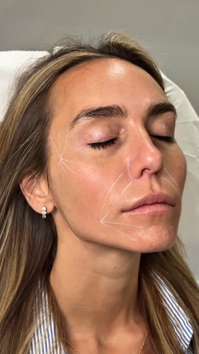 ✨ Restore volume, stimulate collagen, and achieve natural-looking rejuvenation with Sculptra ✨
Unlike traditional fillers, Sculptra works gradually beneath the skin to stimulate your body’s own collagen production helping to restore lost volume, improve skin texture, soften fine lines, and create a firmer, more youthful appearance over time.
💉 Benefits of Sculptra:
• Restores facial volume naturally
• Improves skin firmness and elasticity
• Softens fine lines and wrinkles
• Enhances facial contours
• Gradual, subtle results that don’t look overdone
• Long-lasting collagen stimulation
One of the best parts? Results can last up to 2 years or more with a full treatment course and maintenance. ✨
Sculptra is perfect for anyone wanting a refreshed, natural look that gets better with time.
Book your consultation today to start your collagen journey 🤍