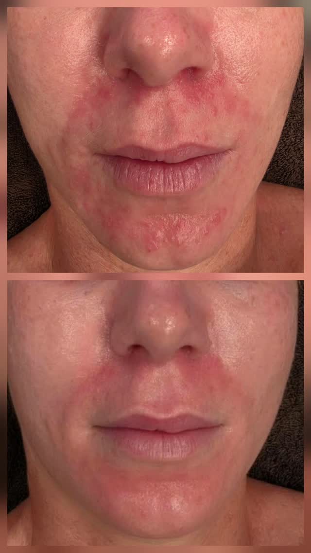 When you start to see the calm immediately after a facial using LED