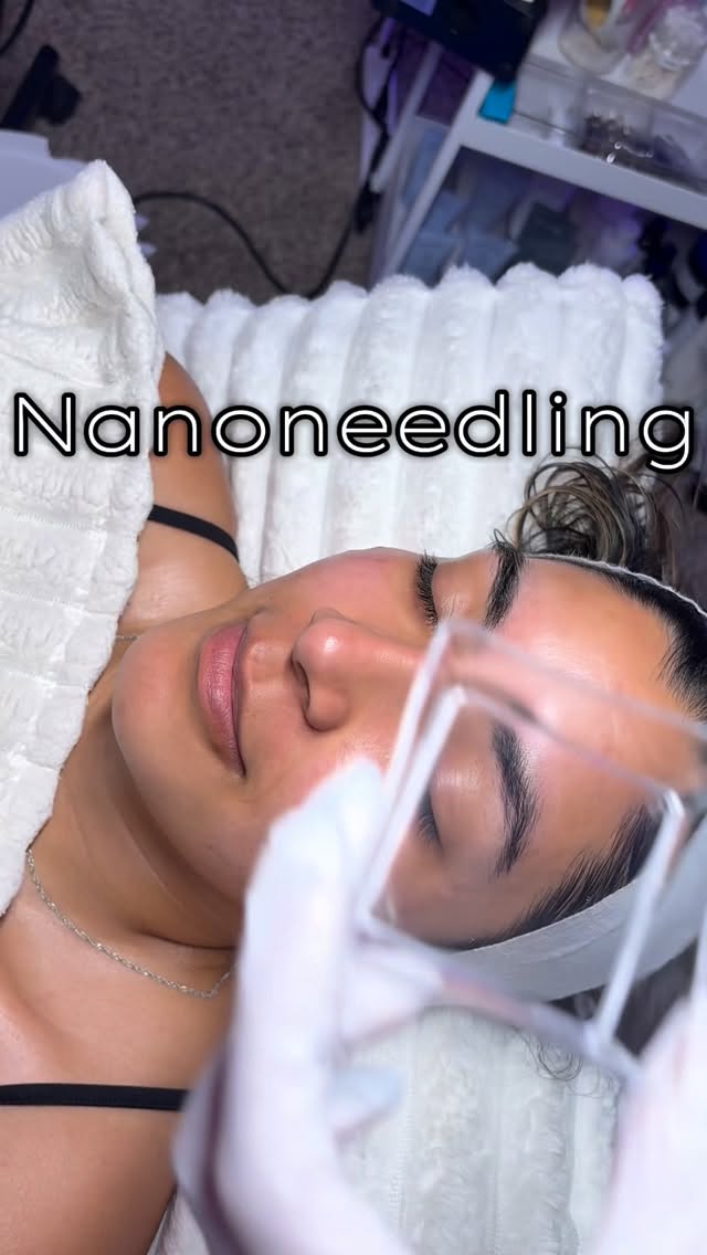 Nanoneedling ❤️
I started seeing my client in October 2024, it’s now April 2026!
Witnessing another skin transformation and healing journey leaves me speechless everytime. 🥺❤️
Consistency in skincare, truly does transform your skin from the inside out! ❤️
#phoenixarizona#nanoneedlingaz#barrierepairaz#arizonaesthetician#azfacial
