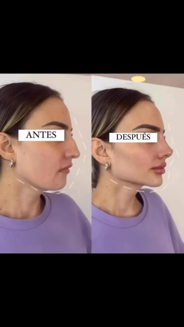 La Colombie, Bogotá… c’est LA référence en chirurgie esthétique et médicale. 🇨🇴✨
Que ce soit pour une chirurgie spécifique… on l’a.
En Colombie, on fait tout, avec des spécialistes de haut niveau.
💬 Dis-moi ce que tu recherches…
Je suis là pour t’accompagner, te conseiller et te guider vers les meilleurs spécialistes, adaptés à TOI.
👉 Écris-moi dès maintenant sur Facebook Messenger
On va regarder ensemble ton projet et trouver la solution parfaite pour toi.
#chirurgieesthetiqueinternational #medicaltourismcolombia #PlasticSurgeryColombia #DentalTourism #BeautyTransformationJourney
@recoveryhomecolombia @medinetco