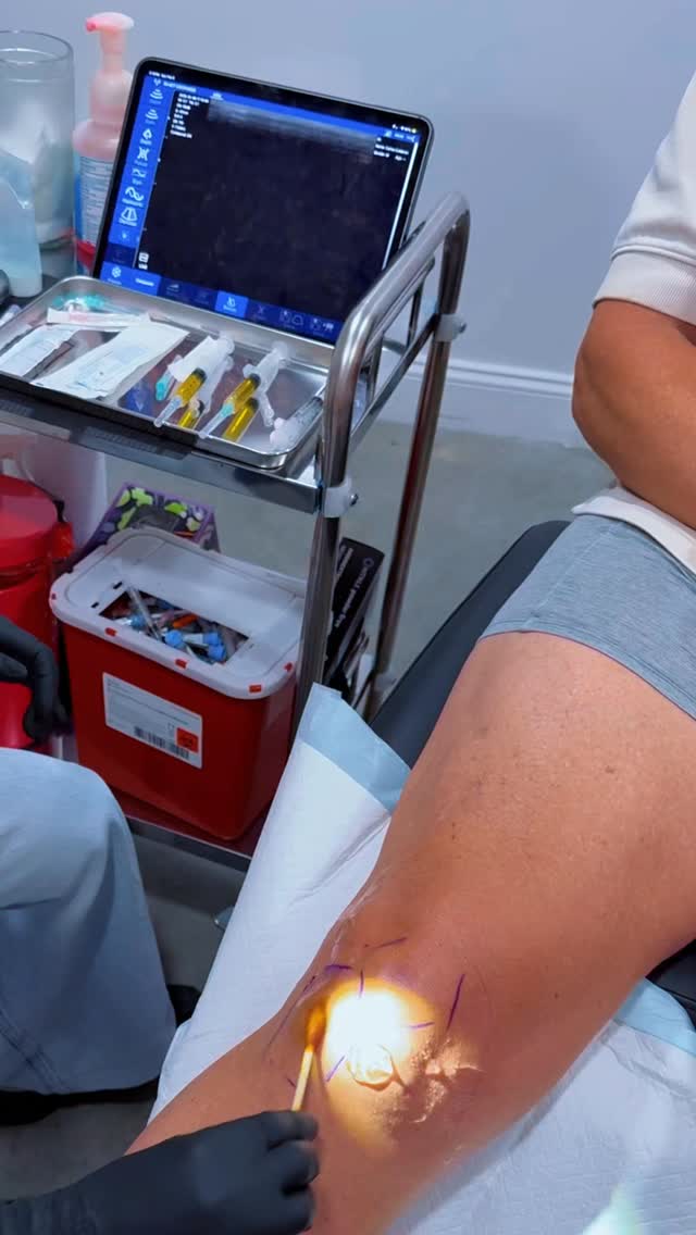 ¿Dolor de rodilla? 🦵⚡
No lo tapes… repáralo desde adentro.
Plasma intraarticular guiado por ultrasonido =
✨ menos dolor
✨ más movilidad
✨ recuperación natural
🔥 PROMO activa
📩 DM “RODILLA” + evaluación GRATIS🇺🇸 Knee pain? 🦵⚡
Don’t mask it… fix it from within.
Ultrasound-guided plasma =
✨ less pain
✨ better movement
✨ natural healing
🔥 PROMO available
📩 DM “KNEE” for FREE evaluation #prptherapy #prpkneeinjection #plasmaricoenplaquetasprp #prptreatment