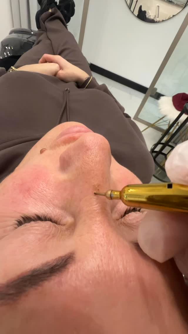 Plasma Pen ❤️
#plasmapen #pigmentflecken