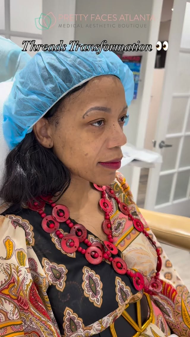 2026 called… it said get Threads ✨
Why? Because PDO Threads help lift sagging skin, define your jawline, soften lines, and stimulate collagen for smoother, firmer skin over time 👀 It’s one of the best ways to refresh your look without surgery or long downtime.
Right now only $225 per thread 🔥 The perfect time to invest in results that keep improving.
Book your consultation with @prettyfacesatl today 📍
#PDOThreads #ThreadLift #PrettyFacesAtlanta #AtlantaMedSpa #YouthfulSkin