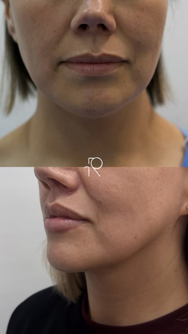 UPPER & DOWN LIP LIFT: labios más juveniles y sensuales | 2 meses de evolución ✨