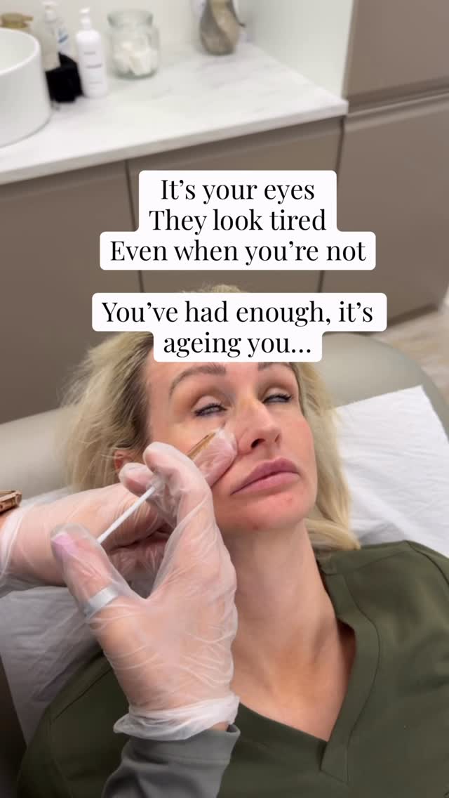 You can sleep.
Drink water.
Do everything right.
And your eyes still look tired.
Heavier.
Darker.
More hollow than they used to be.
This isn’t just skincare.
It’s structural change.
And when treated properly,
it’s one of the most powerful areas to improve.
📩 DM “EYES” for your consultation
📧 hello@lifestyleyou.co.uk
📱 WhatsApp: 07843 841144
#tiredeyes #undereye #facialageing #aestheticclinicuk #naturalresults