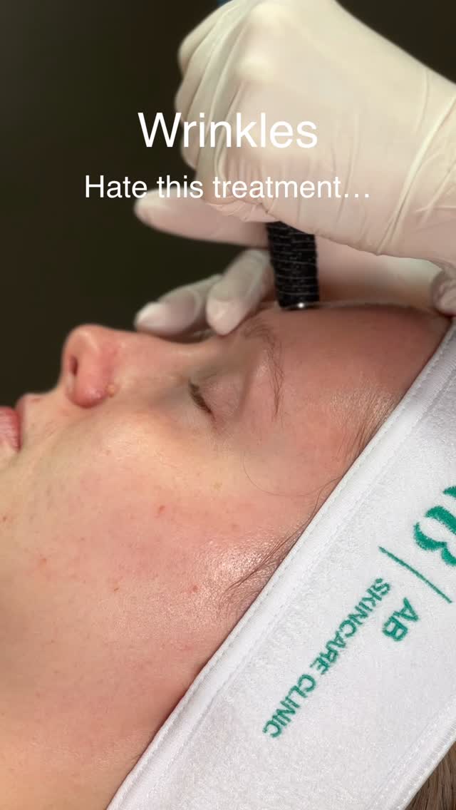 Want to age like a fine red wine? 🍷✨
Then microneedling is a MUST for you 👏
Microneedling helps boost your skin’s natural collagen production.
Which means smoother skin, softer fine lines, improved texture, smaller-looking pores, and that fresh healthy glow everyone asks about 😍
It works by encouraging your skin to repair and rejuvenate itself naturally, helping you maintain firmer, more youthful-looking skin over time ✨
Wrinkles absolutely HATE this treatment… and honestly, we can see why 👀
DM me “MICRONEEDLING” for an exclusive offer on our microneedling packages 💌
❌ Available for the next 24hours only ❌
#Microneedling #SkinClinic #CollagenBoost #AntiAgeingSkin #GlowingSkin
SkinRejuvenationPontyclun
HealthySkin
FineLines
SkinGoals
AestheticClinicTalbotGreen