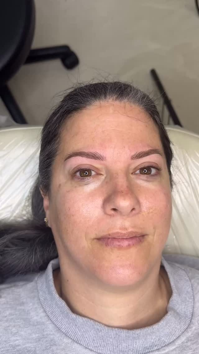 My signature 𝗡𝗮𝗻𝗼 𝗖𝗼𝗺𝗯𝗼 𝗕𝗿𝗼𝘄 technique focuses on strategic placement, with hair strokes at the front and along the top of the brow to keep this section light and airy, while soft shading is added to the lower half to build fullness and definition exactly where it’s needed.
Upon booking, my client initially requested a full set of Nano brows.
However, after a thorough consultation prior to the procedure, and by reviewing multiple examples together, it became clear to me that a full set of hair strokes was not the ideal result she had envisioned. Her goal was a more filled-in, defined brow that would eliminate the need for daily makeup. It’s important to understand that while Nano hairstrokes are very beautiful and natural, they may often be even more subtle than clients expect and in this specific case, this isn’t what my client was hoping for.
Most clients are not familiar with the differences between terms and techniques and will often times request “Nano Brows” or “Microblading” simply because those are the most commonly known terms.
It is important to understand that our role as artists and experts goes beyond the application itself. It is our responsibility to properly guide and educate our clients, to understand their vision, speak their language, and direct them toward the technique that will best achieve their desired result.
Pain level: Minimal (numbing is used throughout the procedure)
Healing time: Approximately 7 days
Longevity: Approximately 1.5–2 years, depending on skin type and lifestyle, before a touch-up is recommended
Inquiries + Bookings:
📩 DM for more information
🔗 Booking link in bio
𝙇𝙖𝙫𝙖𝙡 & 𝙈𝙤𝙣𝙩𝙧𝙚𝙖𝙡 𝙉𝙖𝙣𝙤 𝘽𝙧𝙤𝙬𝙨 / 𝘾𝙤𝙨𝙢𝙚𝙩𝙞𝙘 𝘽𝙧𝙤𝙬 𝙏𝙖𝙩𝙩𝙤𝙤 / 𝙋𝙚𝙧𝙢𝙖𝙣𝙚𝙣𝙩 𝙈𝙖𝙠𝙚𝙪𝙥
#NanoBrowsLaval
#NanoBrowsMontreal
#nanobrows
#browslaval
#mensbrows
pmubrows
permanentmakeuplaval