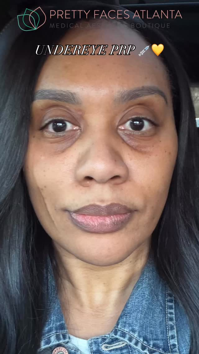 Dark circles. Hollow under eyes. Tired look that won’t go away…
This is your sign to try PRP 👀
Real transformation using your body’s own growth factors to restore volume, smooth texture, and brighten under eyes naturally ✨
No filler. No fake look. Just real skin rejuvenation.
Results get better over time as collagen builds, leaving you looking refreshed, not “done.”
Ready to wake up looking well-rested every day?
Book your consultation now at PrettyFacesAtlanta.com 📲
#PrettyFacesAtlanta #UnderEyeTreatment #PRPResults #NaturalGlow #AtlantaAesthetics