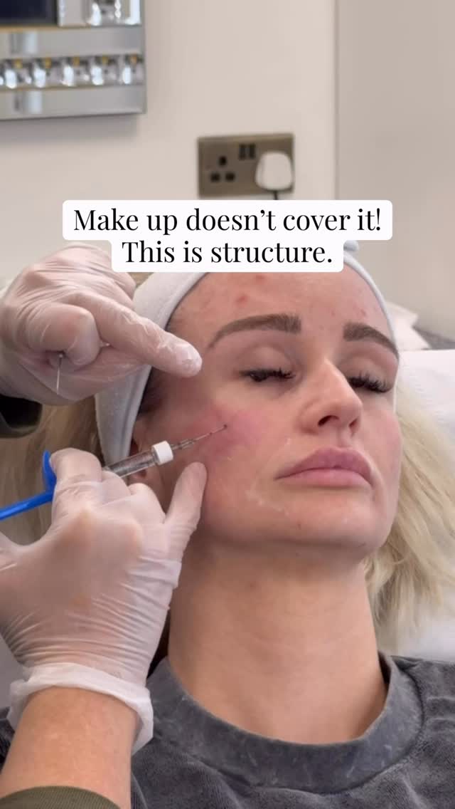 Concealer stops working
when the structure changes.
This client didn’t want to look “done”
just less tired.
So we focused on:
• under-eye support
• subtle volume placement
• improving skin quality
That’s what makes the difference.
📩 DM “PLAN”
📧 hello@lifestyleyou.co.uk
📱 WhatsApp: 07843 841144
#underayefiller #naturalaesthetics #facialbalance #aestheticclinic #skinconfidence