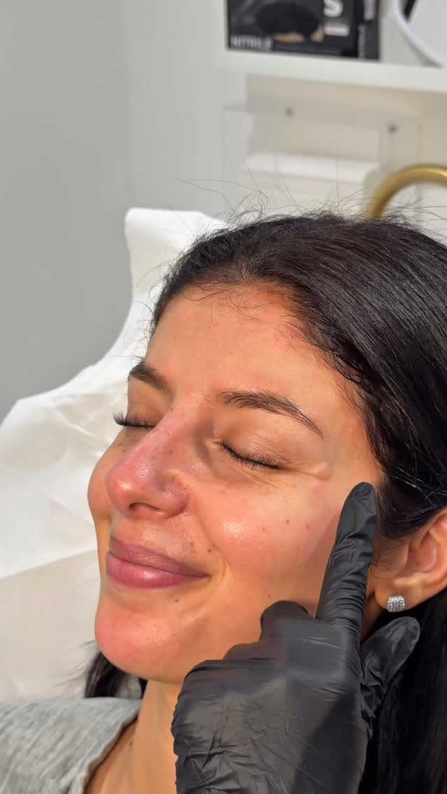 A soft, natural refresh ✨
Baby Botox to smooth fine lines while keeping your movement and expression completely natural.
Just a subtle, fresh look that still feels like you.