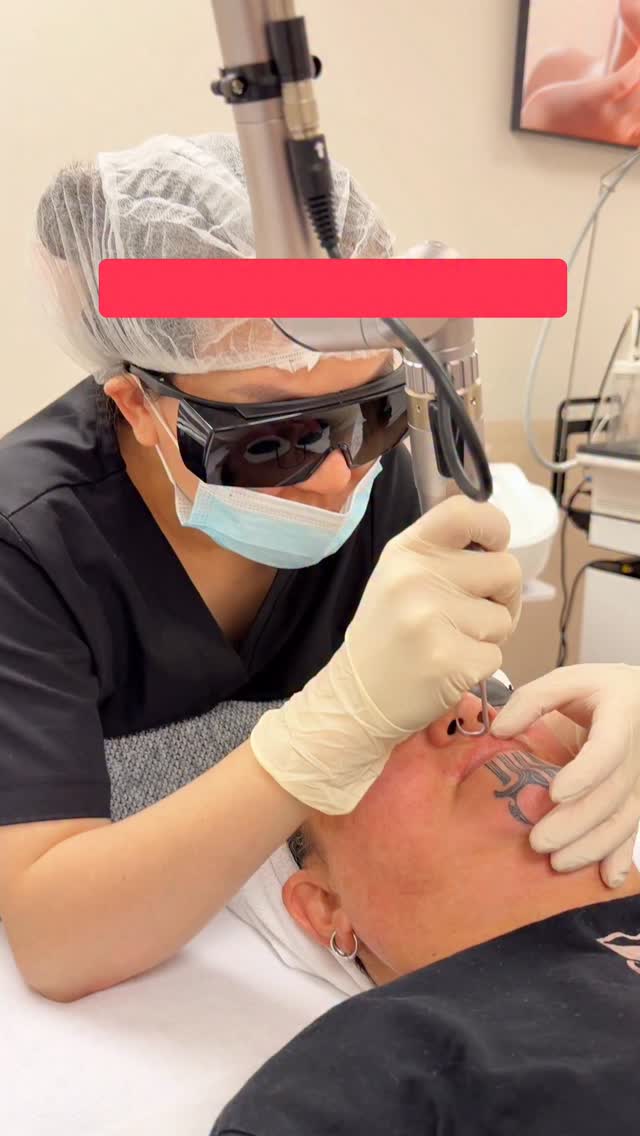💁♀️Long Pulse Laser in the process to get rid of stubborn hairs on upper lips 💪💪💪
📥Inbox us to get permanent hair removal!!! We have IPL and LP Laser solutions that will help to get rid of the most stubborn hairs🤩🤩
#iplhairremoval #upperliphairremoval #longpulselaser #wellington #fabulashbrowsandaesthetics