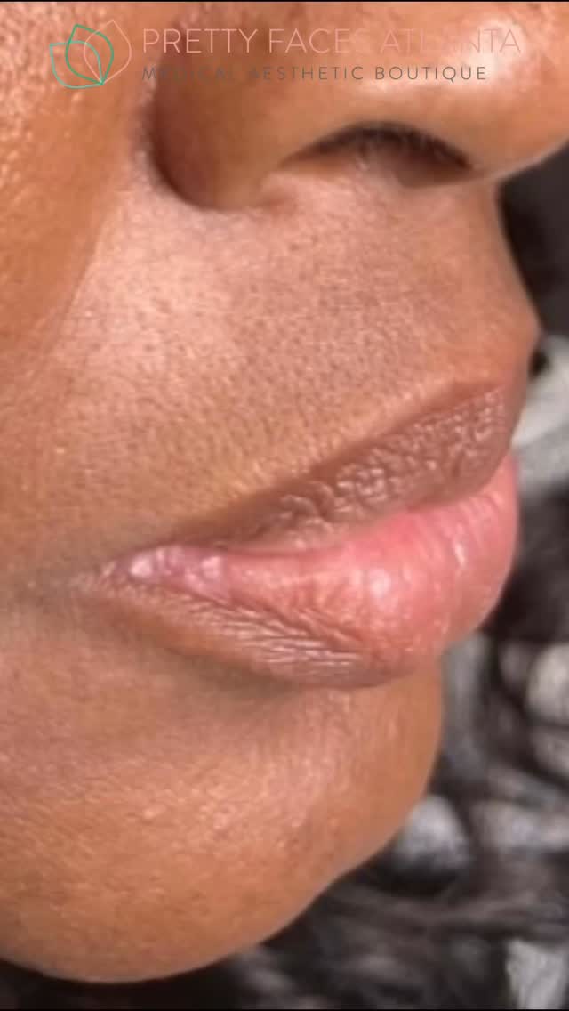 Buy ONE syringe, get ONE FREE 💉🔥
Double the product. Double the results. Same appointment.
This is how you really transform your look… not small tweaks, but full facial balance. Lips with shape, jawline with structure, chin with definition… everything working together.
Filler done right doesn’t look “done”… it just looks better. Sharper. Smoother. More YOU.
If you’ve been waiting for the perfect time, this is it.
Spots are limited and this deal will not last. Book now at PrettyFacesAtlanta.com 📲
#prettyfacesatl #fillerdeal #lipfiller #facialbalancing #atlantaaesthetics