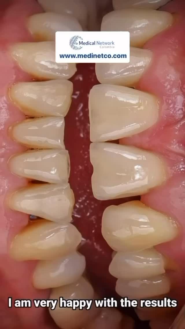 Témoignage d’une cliente très satisfaite en Colombie 🇨🇴
Je suis très heureuse des résultats. Je recommande vivement cette clinique pour son excellent service, son éthique et son grand professionnalisme.
Je repars heureuse, comblée et reconnaissante. Mon sourire a complètement changé, je me sens totalement différente et transformée.
Merci du fond du cœur à toute l’équipe pour l’attention merveilleuse que j’ai reçue. Mille mercis !
#medicaltourismcolombia #PlasticSurgeryColombia #BeautyTransformationJourney #DentalTourism #AffordableDentistry
@recoveryhomecolombia
@medinetco