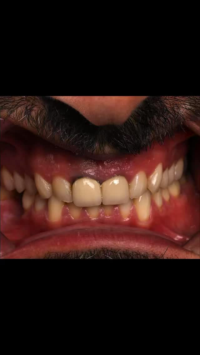 🌟Porcelain Veneers 🌟
Porcelain veneers are not all the same! We have added natural details to the veneers and a glass like finish to the veneers to finish with this rejuvenating smile.
DISCLAIMER
All information provided by Dr Matthew El Azzi - DEN0001996783, Registered Dentist, is for general and educational purposes only. It does not constitute medical advice and should not be relied upon as a substitute for professional consultation.
Images and videos are of real patients who have given consent. No filters, AI enhancements, or unrealistic lighting are used. These materials are intended to demonstrate examples of treatment but do not guarantee results. Individual results, risks, potential complications, and recovery times vary between patients.
Patient stories are individual experiences and should not be interpreted as indicative of expected outcomes for all patients. Your experience may differ.
Before commencing any treatment, you should seek independent advice from a qualified, AHPRA-registered health practitioner and consider obtaining a second opinion.
For details about each specific treatment, head to:
https://www.iconicsmiles.com.au
Dr Matthew El Azzi - DEN0001996783
Registered Dentist, General Registration