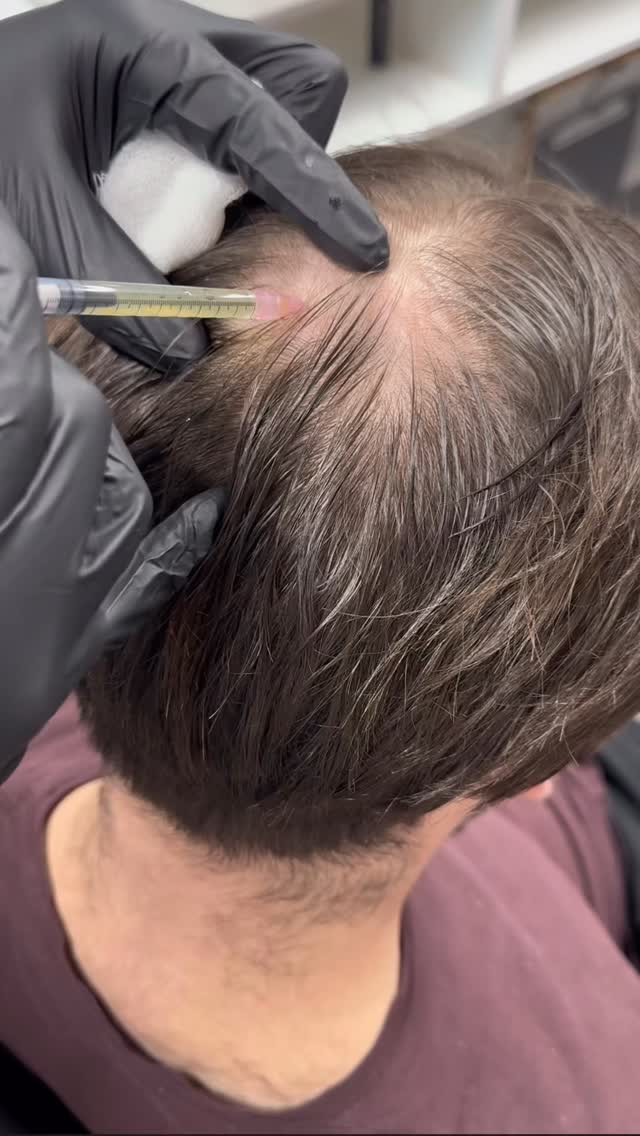 An example of PRP hair rejuvenation ✨
PRP (Platelet-Rich Plasma) is a natural treatment designed to support healthier, stronger hair growth using your body’s own healing properties.
By concentrating growth factors from your blood and carefully reintroducing them into the scalp, PRP can help:
✨ Stimulate hair follicles
✨ Improve hair thickness and quality
✨ Support areas of thinning
✨ Encourage healthier hair growth over time
Results develop gradually, making this a great option for those looking for a more natural approach to hair restoration 🤍
Consistency and the right treatment plan are key — healthy hair growth is a journey, not an overnight fix.
Thinking about starting your hair restoration journey?
DM to book your consultation 📩
#PRPHairTreatment #HairRejuvenation #HairRestoration #NaturalAesthetics #PRPTherapy
