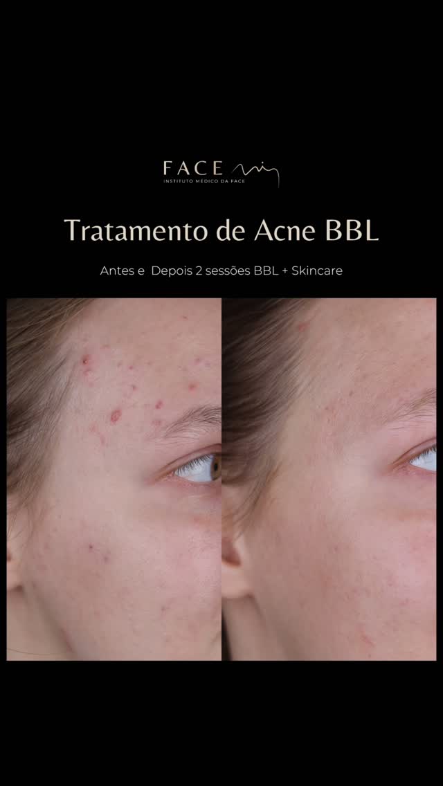 Viver com acne já não é o que era. A tecnologia BBL veio para dar resposta ao acne adulto de uma forma minimamente invasiva.
Uma skincare adaptada e 2 sessões de BBL foram suficientes para melhorar o acne da nossa paciente.
⭐️ Saiba como o BBL a/o pode ajudar.
#Acnehormonal #bblacne #facemi #medicinaestetica
Os casos clínicos apresentados refletem o antes e depois de pacientes específicos. Cada pessoa é única e o resultado pode variar de paciente para paciente.
Todos os pacientes, antes de cada procedimento, passam por um processo de consulta médica de diagnóstico onde são avaliadas indicações, expectativas e motivações.
Registo ERS: 21236
Registo estabelecimento: E159774
Licença funcionamento: 21236/2022