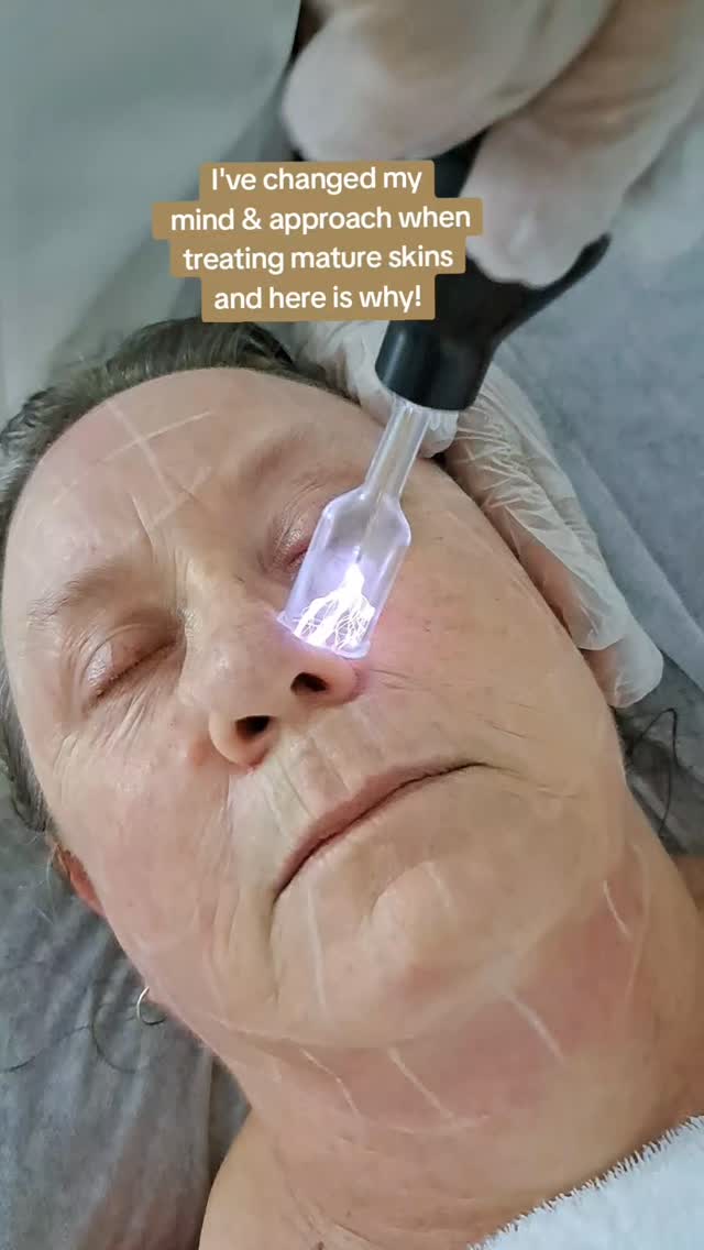 Once upon a time ( Mary ) came requesting a microdermabrasion, expecting a quick fix for her Inflamed, Pigmented Fitzpatrick type 5 skin🤔
But here the thing, how we used to treat these skin condition decades ago, is not how we do things now, and here is why 👇
Mature skins often present with a few concerns at the same time. Fragile, redness Inflamed, and in this case severe Pigmentation & melasma as well😥
The thing is, all these conditions need to be addressed individually and doing harsh treatments looking for a quick fix is not the answer.
So here is how we would approach Mary's skin:
⭐️ Starting with a series treatments focused on nourishing & strengthening her skin barrier.
⭐️Home care products would also have ceremides, peptides & Cholesterol to address redness , inflammation and lack of hydration
⭐️ After a series of salon treatments followed with a well structured homecare routine we assess and start doing Corrective treatments.
⭐️ When starting a skincare journey it's important to keep in mind. Slow & Steady wins the battle.
if this story resonates with you👈 or know someone who needs to hear this please share & Save for later.
@beautyblitzonqueen.
.
.
.#ageingskin
#skinrestore
#skinhydration #matureskin #skinrestore