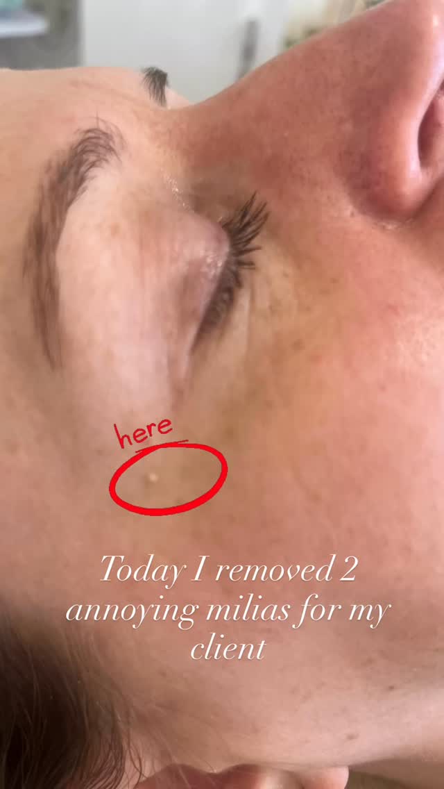 Milias are clusters of keratin , a protein found in the skin.
They can be annoying as you can’t pop them like a whitehead.
Careful lancet extraction is how I get rid of these pesky little pearls.
Do you need yours gone? DM and I will be right here to help
Anna x❤️
#miliaremoval #leightonbuzzardmums #leightonbuzzard #miltonkeynesmums #skinrejuvenation