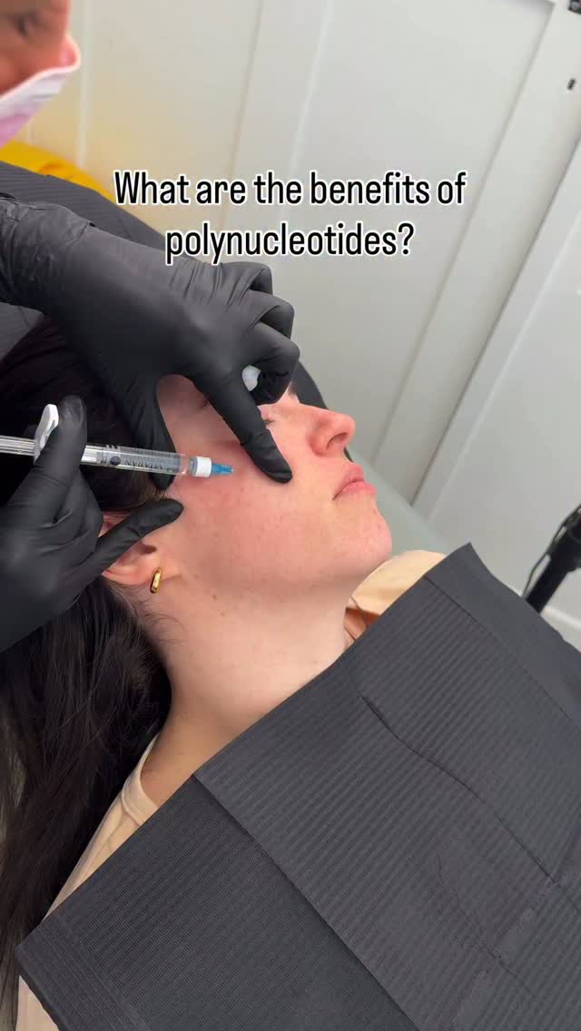 The salmon sperm facial 💧
Let’s talk about it….
What are Polynucleotides?
Bio-revitalising injectable which is composed of highly purified fragments of trout (salmon) DNA - part of a broader class known as polynucleotides.
How they work? 📍
When injected, these molecules stimulate fibroblasts, encouraging the production of collagen, elastin, and hyaluronic acid. This action supports deeper skin rejuvenation, improved hydration, and tissue repair 🧬
Benefits & Why the Buzz 🤔
Long-lasting and natural results
Polynucleotides leverage your body’s natural regenerative mechanisms and can yield improvement lasting 6 to 12 months, following an initial course of treatments
Key outcomes include: 🔑
Reduced fine lines and wrinkles
More even skin tone and improved texture
Enhanced hydration and plumpness
Youthful glow & glowier complexion
Typically 2–3 sessions, spaced 3–4 weeks apart, are recommended for optimal results. Maintenance “top-up” sessions can follow every 6 to 12 months.
Visible results timeline ⏰
Subtle changes may begin around 2–6 weeks after the first session.
Noticeable improvements often appear 4–6 weeks after the third session, with full effects seen at around 3 months
💰£130 for under eye only
£200 for full face including under eye
📍Barnham & Chichester