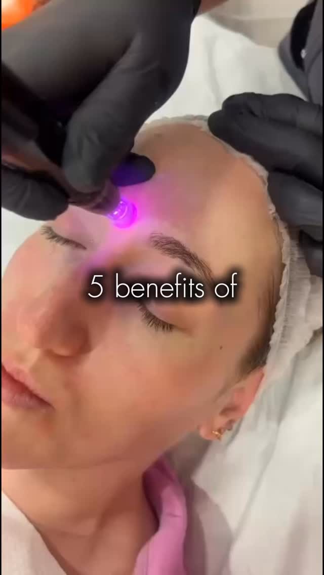 5 benefits of microneedling ✨💉
Microneedling does more than give you a glow, it works beneath the surface to support healthier, smoother-looking skin.
✨ Stimulates collagen & elastin
✨ Helps soften fine lines & wrinkles
✨ Improves the appearance of acne scars
✨ Brightens uneven skin tone & pigmentation
✨ Leaves skin smoother, fresher & glowing
Ready for your skin glow-up? Link in my bio to book💫
#Microneedling #SkinRejuvenation #SkinGoals #GlowingSkin #CollagenBoost BeautyClinic Aesthetics HealthySkin SelfCare GreystonesClinic WicklowClinic