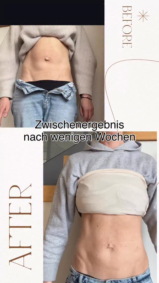 Schau dir das mal ganz genau an. Ich habe hier bewusst die Muttermale markiert.
Nicht, weil sie an sich wichtig sind, sondern weil sie dir zeigen, was wirklich im Körper passiert ist.
Du siehst hier ganz klar: Weniger Zug im Gewebe. Weniger Spannung. Weniger Druck nach außen.
Genau das ist der Punkt, den die meisten komplett übersehen. Es geht nicht nur darum, wie dein Bauch aussieht.
Sondern was im Inneren passiert. 🚀 Und genau da setzen wir an. Wenn du mit uns startest, gehst du nicht einfach nach Hause mit ein paar Übungen. Du lernst zu verstehen, wie deine Körpermitte wirklich funktioniert.
Du baust wieder Verbindung auf.
Du spürst, wie sich dein Körper verändert, nicht nur optisch,
sondern im Gefühl von Stabilität, Kontrolle, Vertrauen und neuem Selbstwert und Selbstbewusstsein.
Und genau das ist der Unterschied. 🤍 Wir sehen dich, wir helfen, heilen gemeinsam, nachhaltig.
Nicht schneller, Nicht mehr.
Sondern endlich richtig. Du bist nicht allein.
Zurück zu dir, deinem neuen ich, zu mehr Stärke. 🤍
Kommentiere 🚀 wenn du Ende Mai auch solche Ergebnisse haben möchtest, wir haben noch 5 Plätze frei.
Ps: unsere Kundin, startet jetzt wieder ins Crossfit, step by Step!