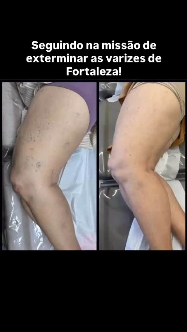 Resultado do comprometimento da paciente e da utilização da tecnologia adequada para o tratamento. #adeusvasinhos