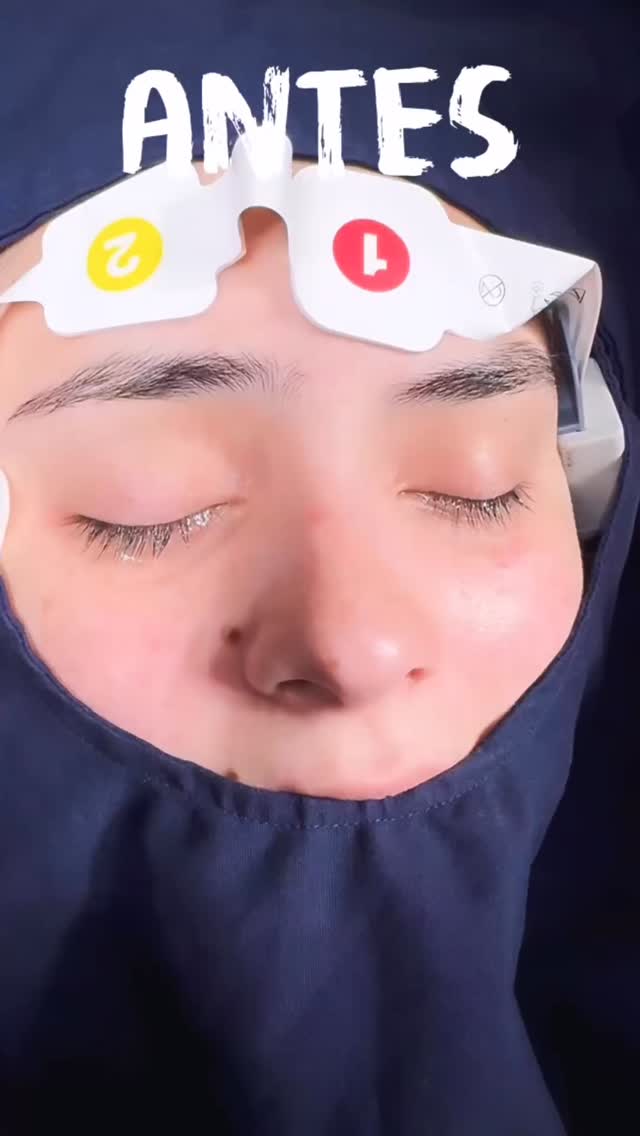 🔹Cada procedimiento es personalizado, planificado con precisión y ejecutado con técnica y experiencia. La Rinoplastia es arte y ciencia combinados.
🔹Resultado inmediato Rinoplastia Estética y Funcional.
🔹 Gracias a mi excelente paciente por su confianza y permitir compartir su resultado.
🔹”Made by hand. Crafted with passion”
🧑⚕️ Dr. Guillermo Guerra Gil de Leyva
🏥 Hospital Ángeles Valle Oriente
📱 81-1252-0132
🎓Universidad de Monterrey
👃 Rinoplastia Estética y Funcional
🚫 No taponamiento
Cédula Profesional: 3070499
Cédula Especialista: 4503273
No. Certificación CONACEM: GUG-1748/04
Aviso de Publicidad COFEPRIS: 2419032002A00111
❕Paciente autoriza difusión de imágenes con fines académicos e informativos.
❕Los resultados finales se pudieran observar hasta un año de la cirugía y dependerá tanto del compromiso del cirujano como del paciente, así como del tipo de cirugía, tipo de piel, cuidados post-operatorios, etc.
#CirugíaFacial #RinoplastiaEspecializada
#rinoplastia #rhinoplasty #septoplastia septoplasty rinoseptumplastia rhinoseptoplasty nosejob nose nosesurgery tabiquenasal otorrinolaringologia entsurgery cirugianasal cirugiatabique cirugiaesteticanasal
belleza confianza autoestima
cosmeticsurgery
otorrinolaringologiamonterrey otorrinomonterrey beforeandafter antesydespues
estructuredrhinoplasty
rinoplastiaestructurada
rinoplastiaultrasonica
ultrasonicrhinoplasty