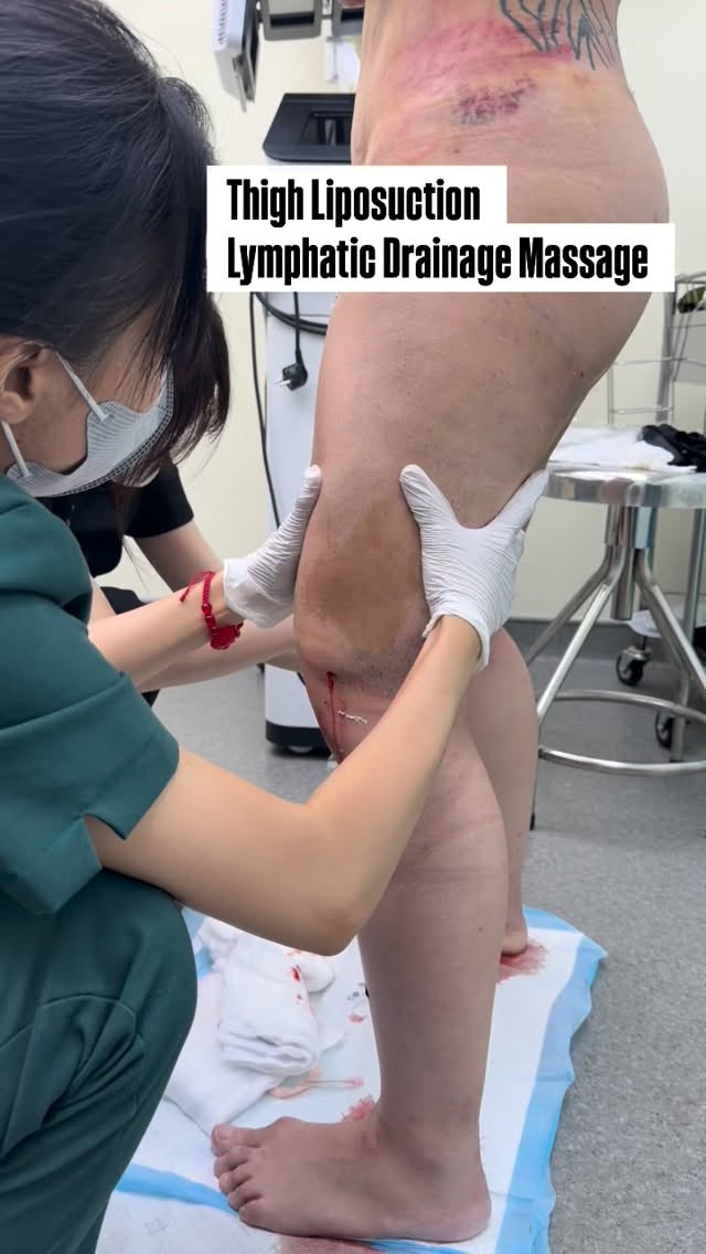 Post-Thigh Liposuction Lymphatic Drainage Massage – Benefits
1. Reduces swelling and fluid retention
After liposuction, lymphatic fluid can accumulate under the skin. This massage helps move the fluid out, speeding up recovery.
2. Prevents fibrosis (hard lumps)
Without proper care, the treated area may become hard or uneven. Lymphatic drainage helps keep the tissue soft and smooth.
3. Minimizes bruising
Improves blood circulation, helping bruises fade faster.
4. Enhances final contour results
Helps distribute tissue evenly, creating a smoother, more refined thigh shape.
5. Relieves discomfort and tightness
Gentle pressure reduces pain and the feeling of heaviness after surgery.
#medicaltourism
#plasticsurgery #rrbeauty #fatremoval #lipoaspiração