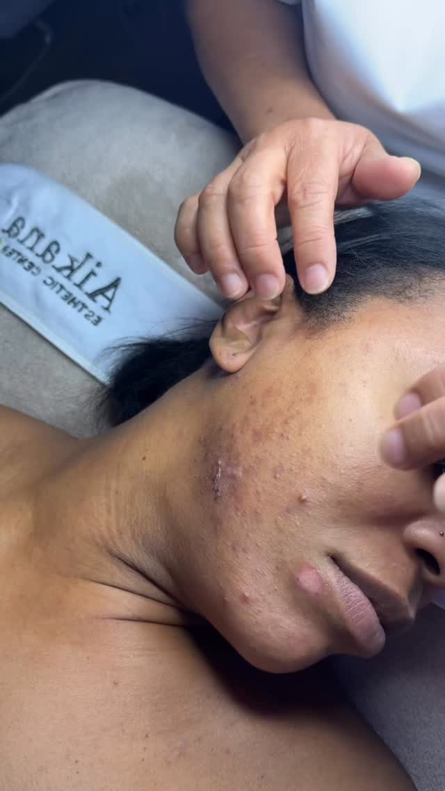 Real Skin, Real Results ✨
This transformation didn’t happen overnight (Results took 4 months) but 5 months later, her skin is still clear of the deep congestion, stubborn texture, and hormonal breakouts that had built up over years.
So, how did we get here?
🤍Targeted extraction facials congestion & texture
🤍 Simple, effective homecare (that didn’t break the bank)
🤍 And a plan that was tailored exactly to what her skin
This is what can happen when the guesswork is removed and the right techniques are applied consistently
✨Results that last.
✨Confidence that shows.
✨ And skin that finally works with you and not against you!
#dmvesthetician #skincare #virginiafacials