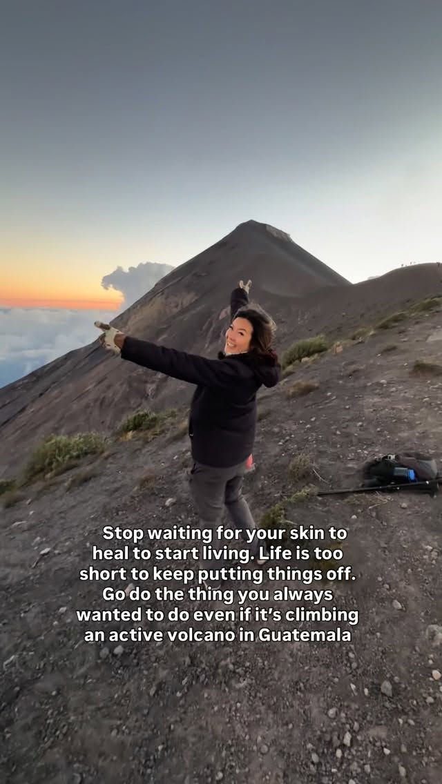 If there’s one thing that changed my healing journey, it’s that I stopped waiting.
I stopped waiting for my skin to heal before doing the things I love (like travelling - a big part of my life)
I stopped waiting to feel better with my body before making plans
I stopped waiting for the “right time”
Because waiting only creates more waiting.
If you’re always waiting for things to get better in your health and in your life, you’ll always be waiting.
The people who truly heal don’t hesitate with their decisions.
They’re the ones who choose to live their life along the journey.
And ironically … that’s when they started to see more healing.
Curious if anyone else feels this way? 🤍
#healingjourney #acatenangovolcano #guatemala #eczemahealing #eczemajourney
